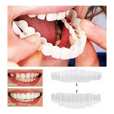 Carillas Dentales Snapon Smile